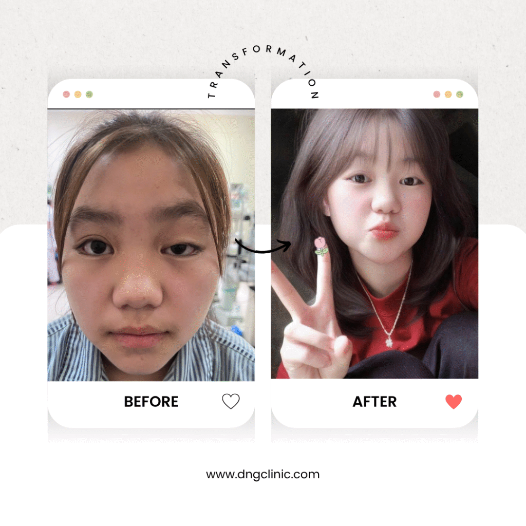 Thẩm mỹ mắt, cắt mí, bóc mỡ, treo cung mày